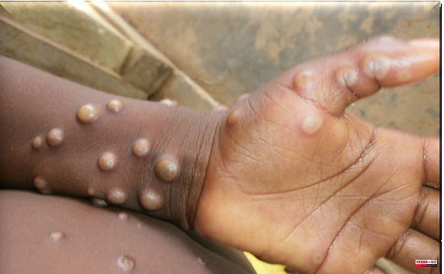 What is the monkeypox that has just appeared in the United Kingdom and what does it imply?