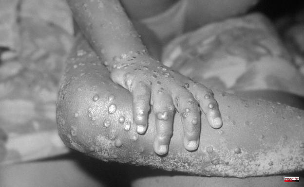 The symptoms of monkeypox that largely affects children and pregnant women