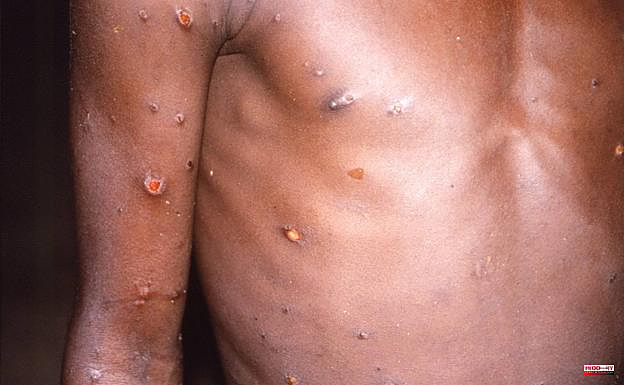 Questions and answers about monkeypox