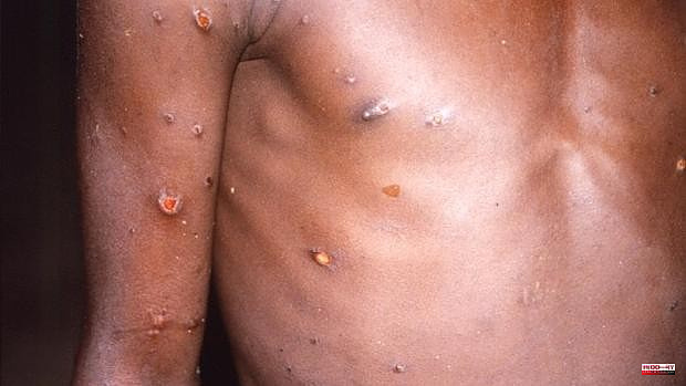 Health rules out all suspected cases of monkeypox in the Valencian Community
