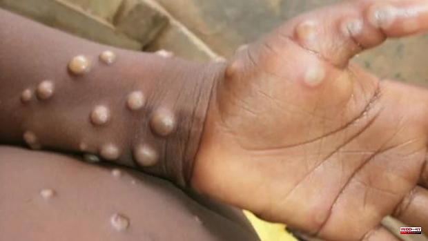 The Canary Islands register the first suspected case of monkeypox