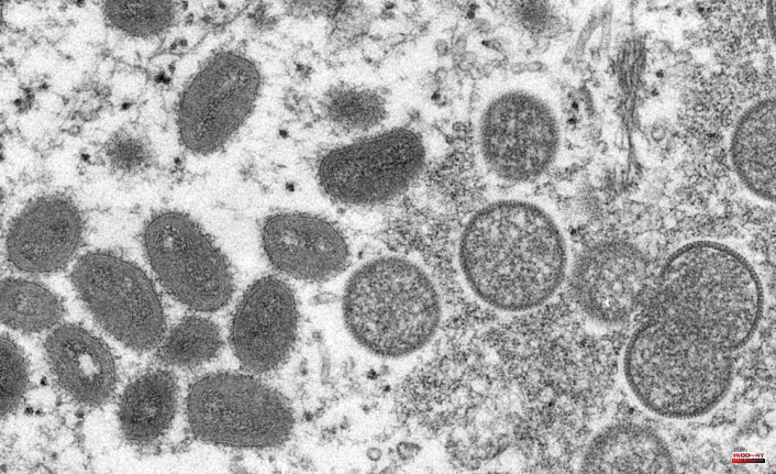 2 monkeypox strains in US suggest possible undetected spread