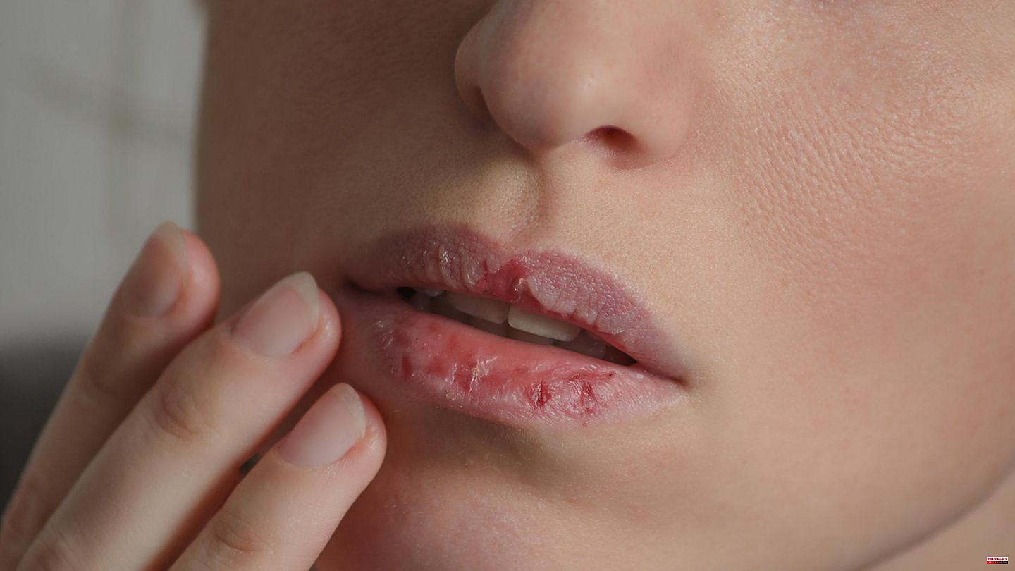 Lack of self-protection: dry lips? You should avoid these mistakes