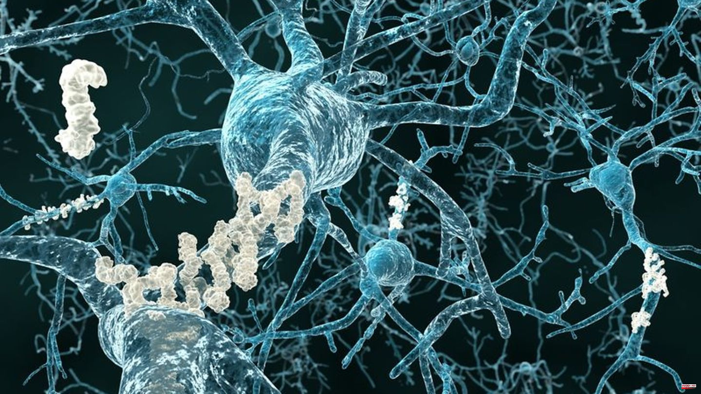 Health: Study: Alzheimer's drug slows mental decline