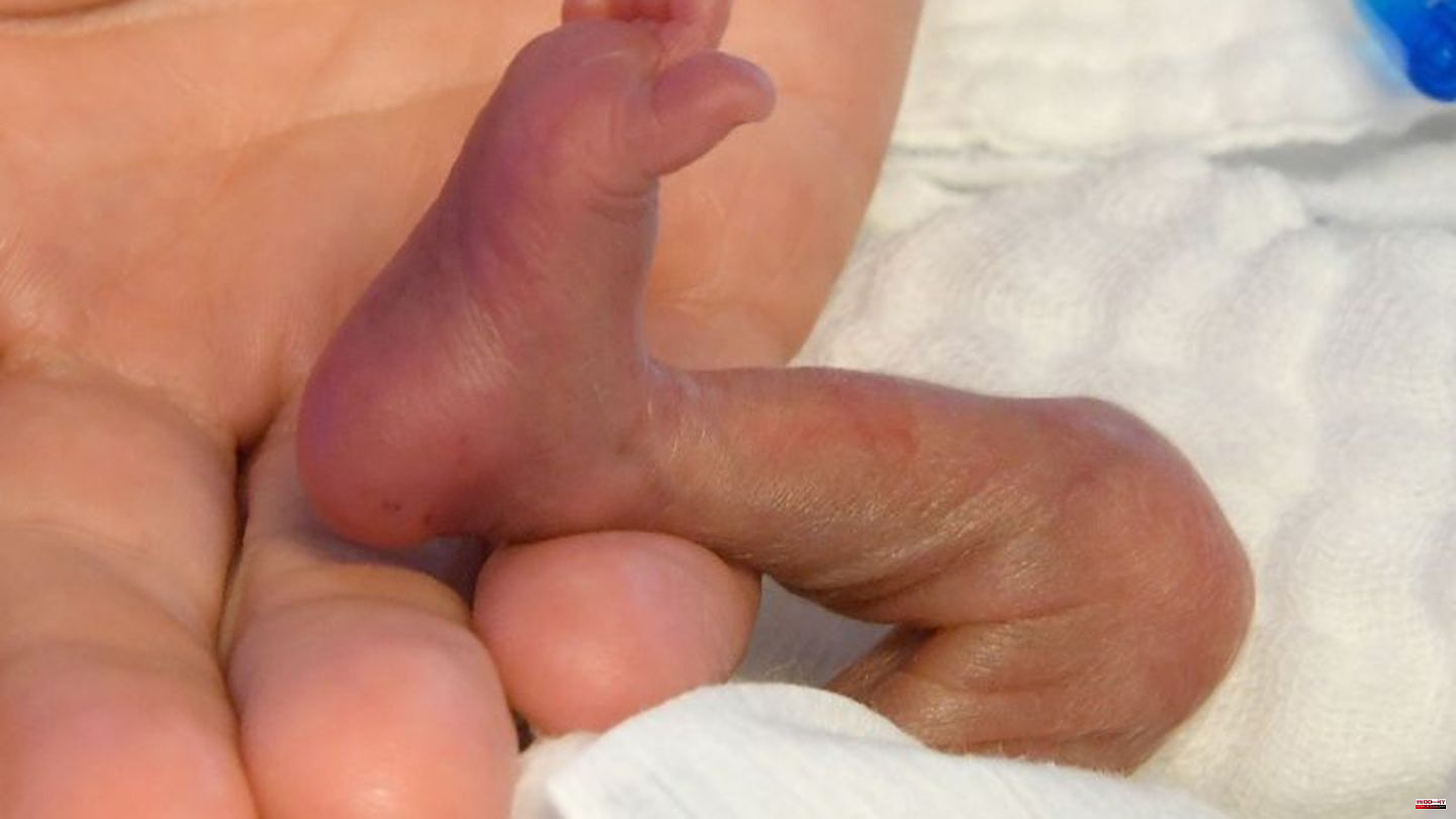 Premature birth: WHO: Premature babies need skin contact - even before the incubator