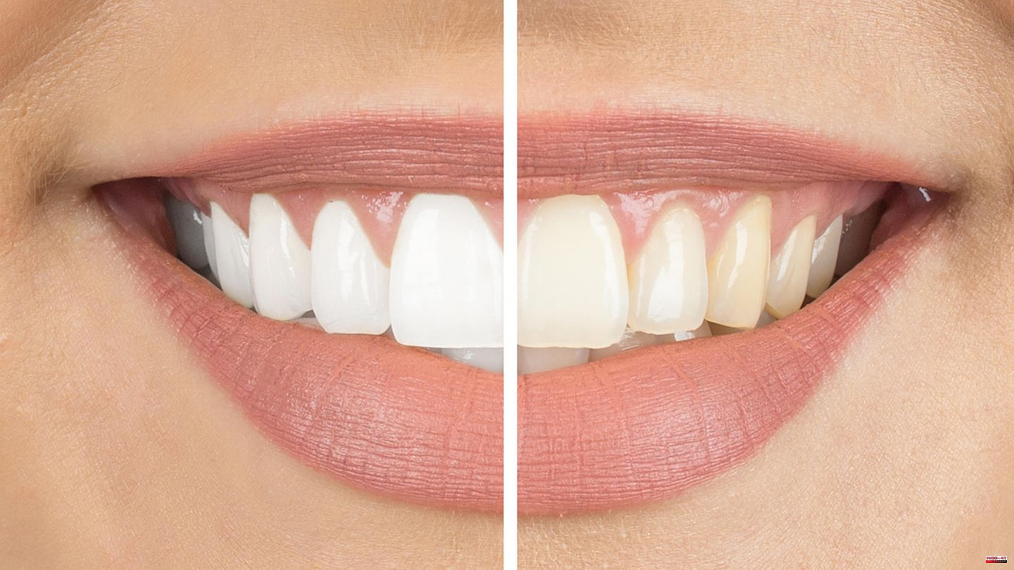 White smile: teeth whitening: These bleaching methods exist – and they do that
