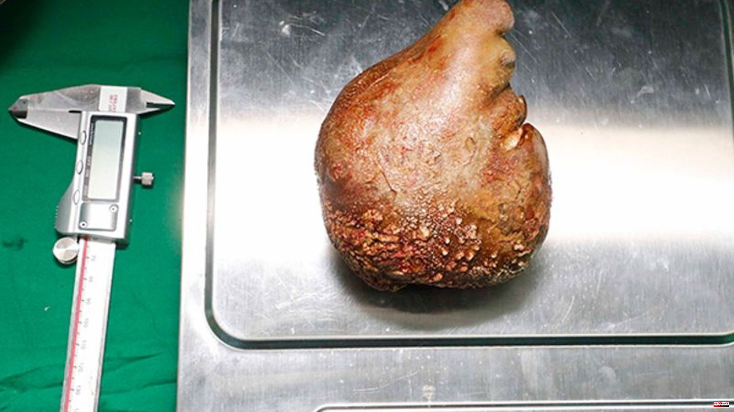 Medicine: Guinness Book of Records: World's largest kidney stone removed