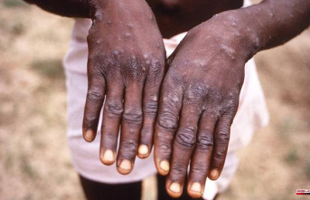 Europe recommends smallpox vaccination for contacts of people infected with monkeypox