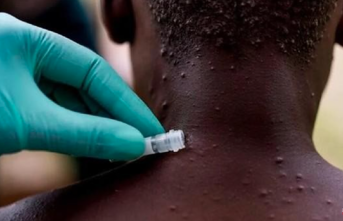 A second suspected case of monkeypox in the Canary Islands is studied and whether a massive party could have been a source of transmission