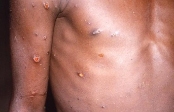 Health rules out all suspected cases of monkeypox...