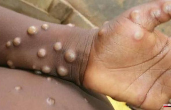 Osakidetza studies the first suspected case of monkeypox infection