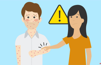 Visual guide to monkeypox: what it is and how it spreads
