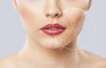 Clear as skin: remove blackheads – your skin will...