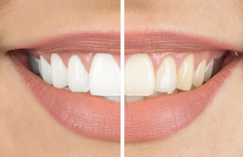 White smile: teeth whitening: These bleaching methods...