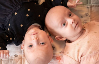 Medicine: Twins conjoined at the abdomen successfully...