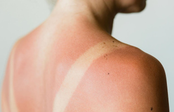 Health tips in the check: Quark is supposed to help against sunburn - is that true?