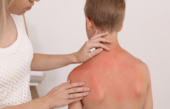 Rash and itching: Treat sun allergy in children in...