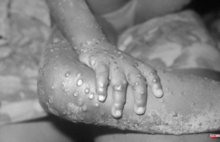 The symptoms of monkeypox that largely affects children...
