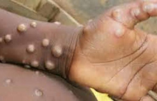 A 31-year-old man, the first case of monkeypox in...