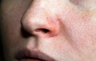 Red veins on the face: Rosacea cream for reddening...