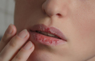 Lack of self-protection: dry lips? You should avoid...