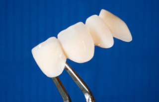 Health: bridge, inlay or implant? These options are...