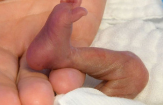 Premature birth: WHO: Premature babies need skin contact...